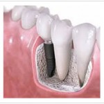 Dental Implants Singapore