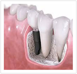 Dental Implants Singapore