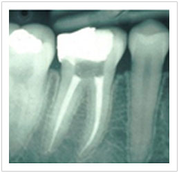 Root Canal Treatment Root Canal Treatment