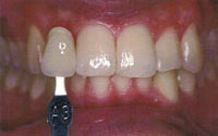in_office_whitening1a