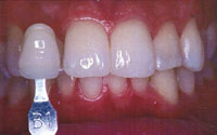 in_office_whitening1b