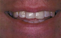 in_office_whitening2a