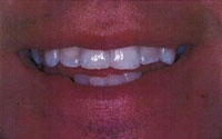 in_office_whitening2b