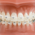 Advantages Of Wearing Braces When You Are In Your Teens