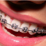 Do Not Let Wearing Metal Braces Singapore Stop You From Enjoying Your Life