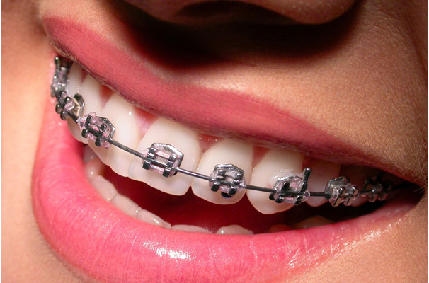 Do Not Let Wearing Metal Braces Singapore Stop You From Enjoying Your Life