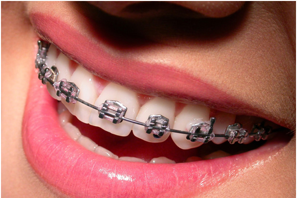 Enjoy Wearing Metal Braces Singapore