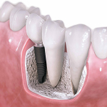 3 Advantages of Dental Implants Over Dentures