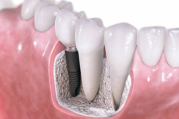 3 Advantages of Dental Implants Over Dentures