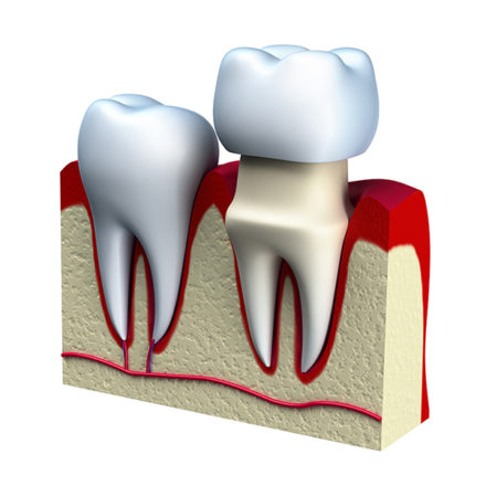 Dental Crowns and Bridges