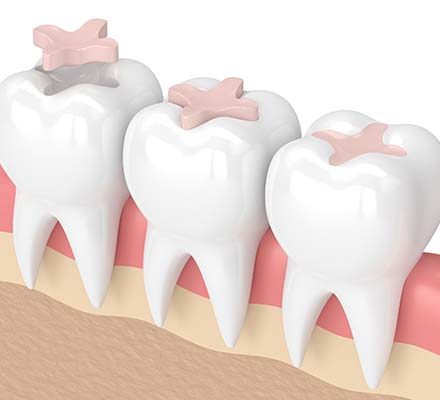 Tooth-coloured fillings