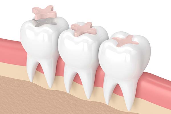 Tooth-coloured fillings