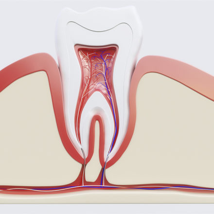 Root Canal Treatment