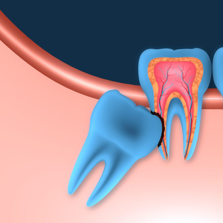 Wisdom Teeth Removal