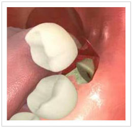 Wisdom Teeth Removal Singapore